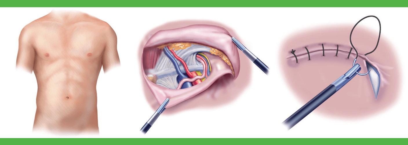 Laparoscopic Hernia Surgery 8628