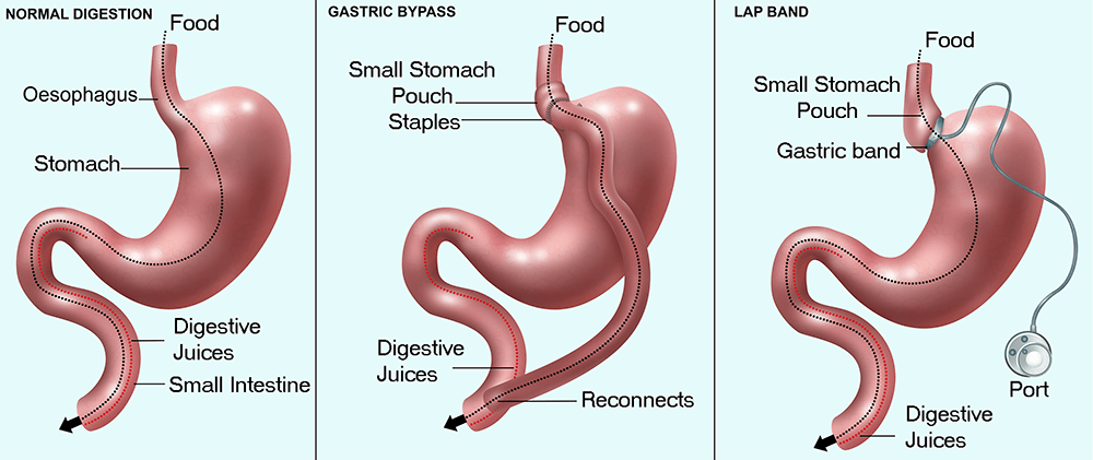 Types Of Bariatric Surgery For Weight Loss