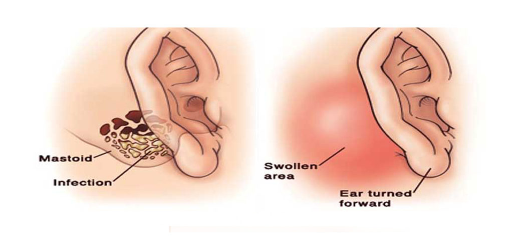 tympanomastoidectomy